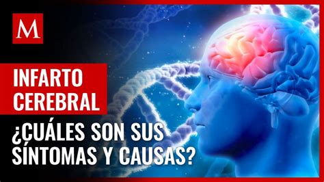 que es un infarto cerebral